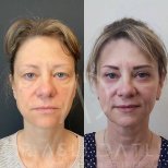 Vorher-nachher-Ergebnis Fox Eye Lift bei Liv Hospital Ulus, sichtbare Lid- und Brauenstraffung