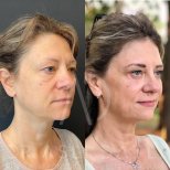 Vorher-nachher-Ergebnis Fox Eye Lift bei Liv Hospital Ulus, sichtbarer Lid- und Brauenlift