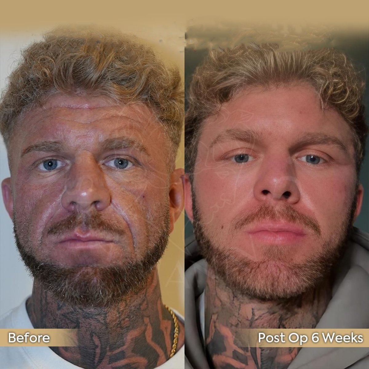 Facelift before and after results at Dr. Safa Manav Clinic, visible facial rejuvenation