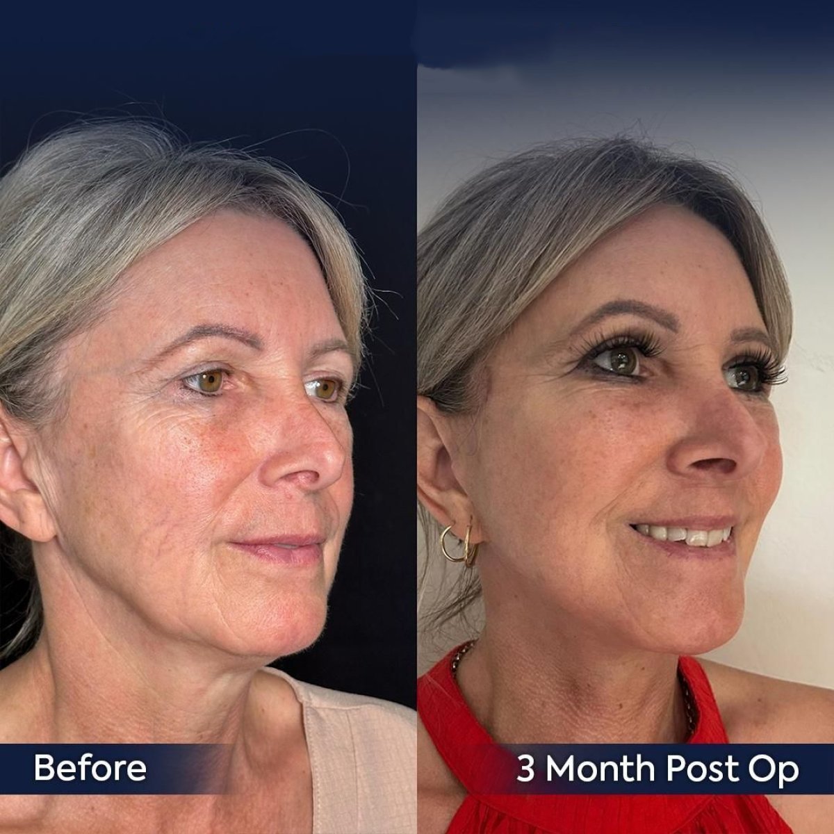 Facelift before and after results at Dr. Safa Manav Clinic, visible facial rejuvenation