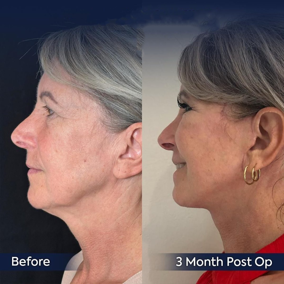 Facelift before and after results at Dr. Safa Manav Clinic, visible jawline and neck lift