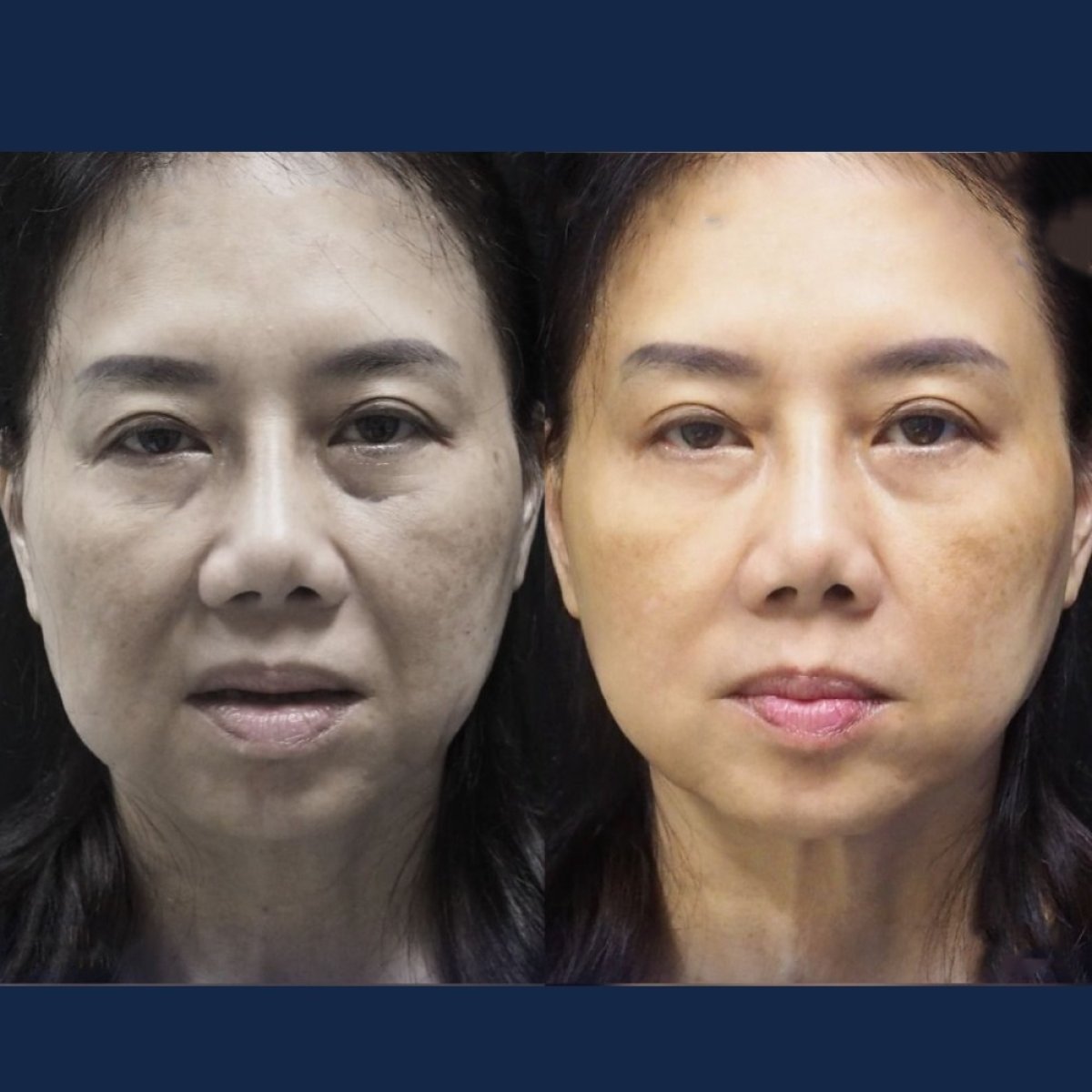 Результати до і після підтяжки обличчя в Yanhee International Hospital, омолодження