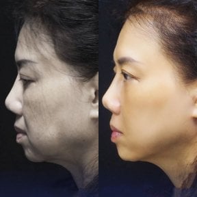 Résultats avant et après lifting du visage à Yanhee International Hospital, rajeunissement