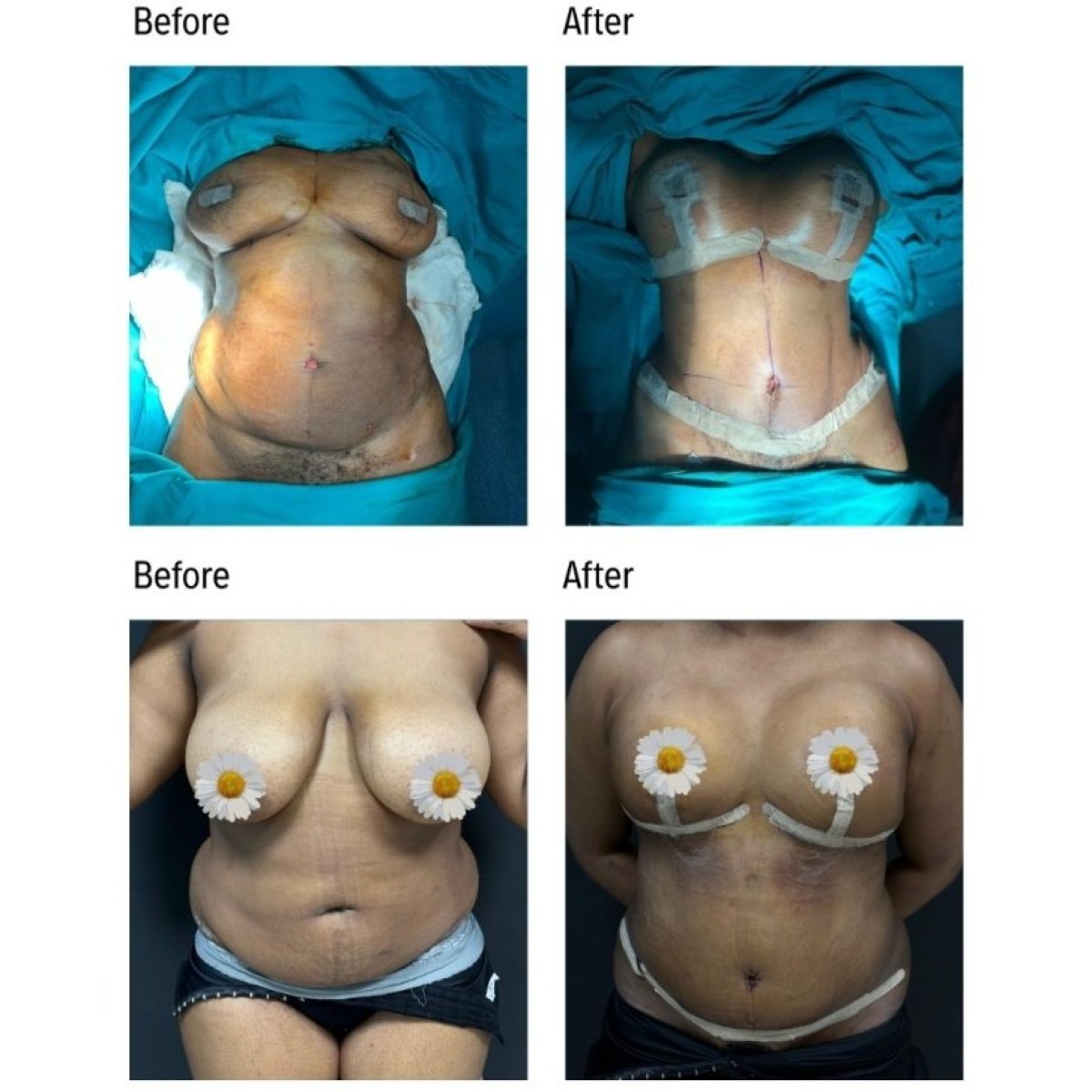 Vorher-nachher-Ergebnisse Bauchdeckenstraffung und Fettabsaugung bei Soraca Med Istanbul