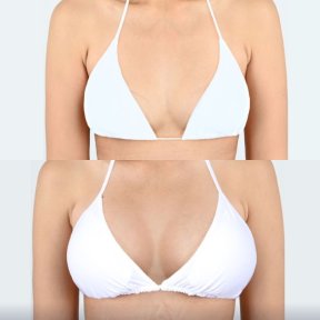 Before and after breast augmentation with silicone implants at Dr. Chen Surgery Hospital result