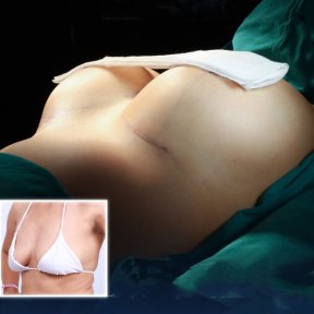 Before and after breast augmentation with silicone implants at Dr. Chen Surgery Hospital result