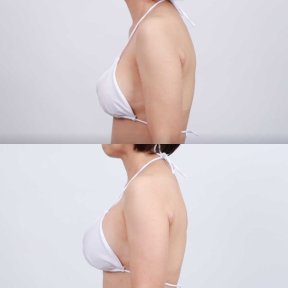 Before and after breast augmentation with silicone implants at Dr. Chen Surgery Hospital result