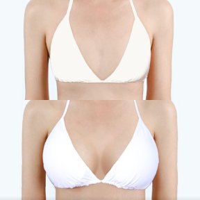 Before and after breast augmentation with silicone implants at Dr. Chen Surgery Hospital result