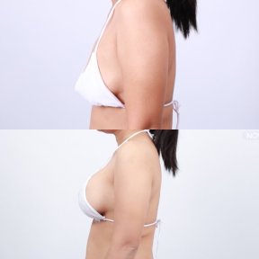 Before and after breast augmentation with silicone implants at Dr. Chen Surgery Hospital result