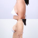 Before and after breast augmentation with silicone implants at Dr. Chen Surgery Hospital result