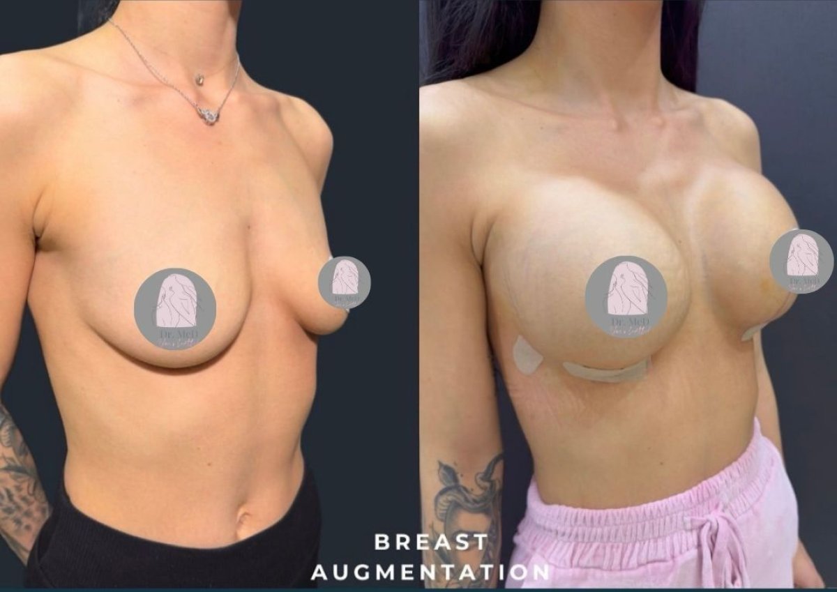 Результаты до и после увеличения груди в клинике Dr. MED, увеличенный объем груди