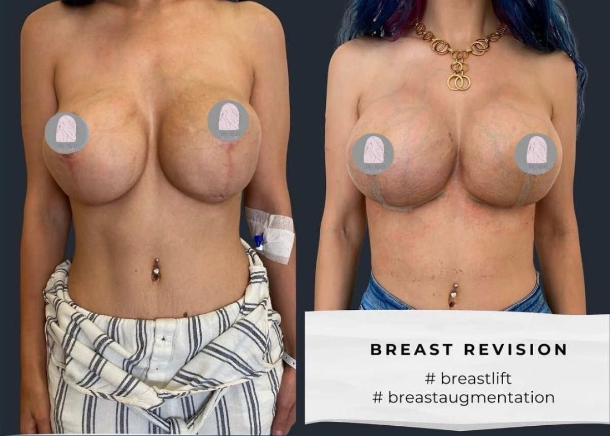 Результаты до и после увеличения груди в Dr. MED – улучшена форма и симметрия груди