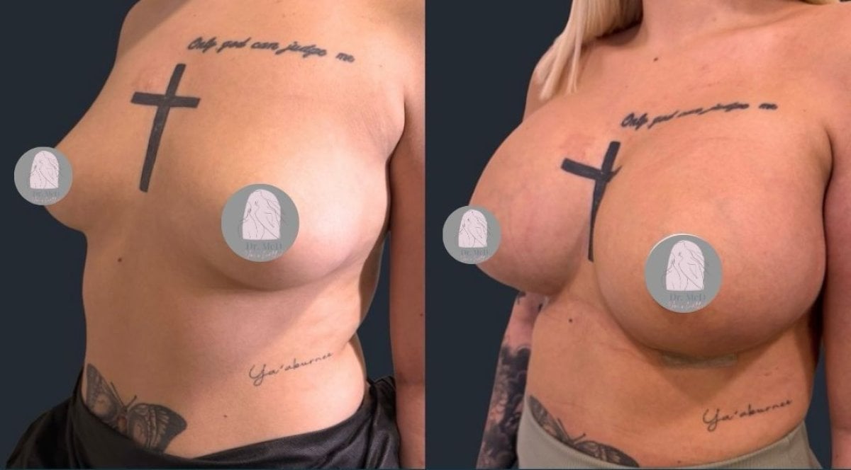 До и после увеличения груди в Dr. MED, результат увеличенного объема и формы груди