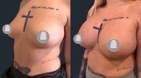 Vorher-nachher Brustvergrößerung bei Dr. MED, verbessertes Volumen und Kontur Ergebnis