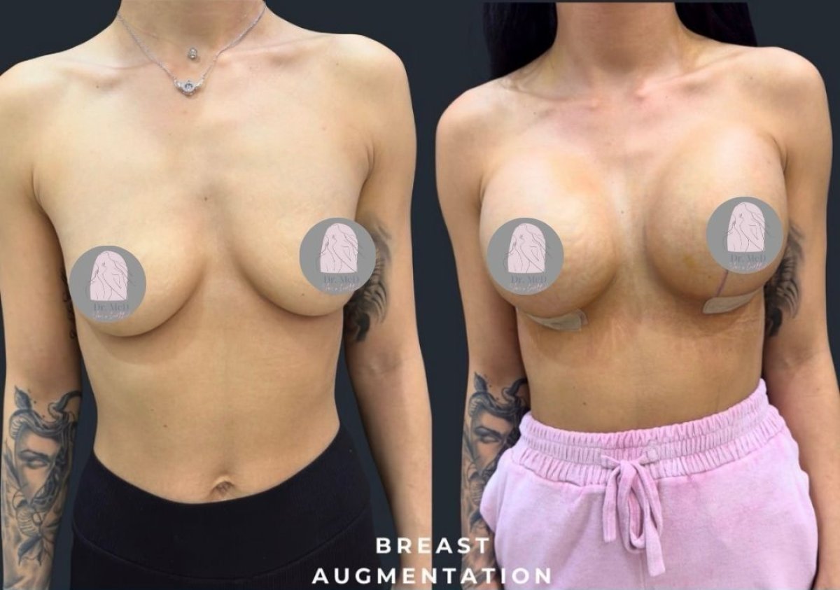 Результаты до и после увеличения груди в клинике Dr. MED, увеличенный объем груди