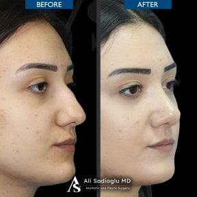 Résultats avant/après rhinoplastie à la clinique Dr. Safa Manav, remodelage du nez femme