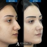 Résultats avant/après rhinoplastie à la clinique Dr. Safa Manav, remodelage du nez femme