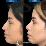Resultados de rinoplastia antes y después en Dr. Safa Manav Clinic, remodelación nasal femenina