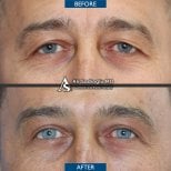 Vorher-nachher-Ergebnis der Ober- und Unterlidstraffung in der Dr. Safa Manav Klinik