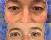 Vorher-nachher-Ergebnis der Ober- und Unterlidstraffung in der Dr. Safa Manav Klinik