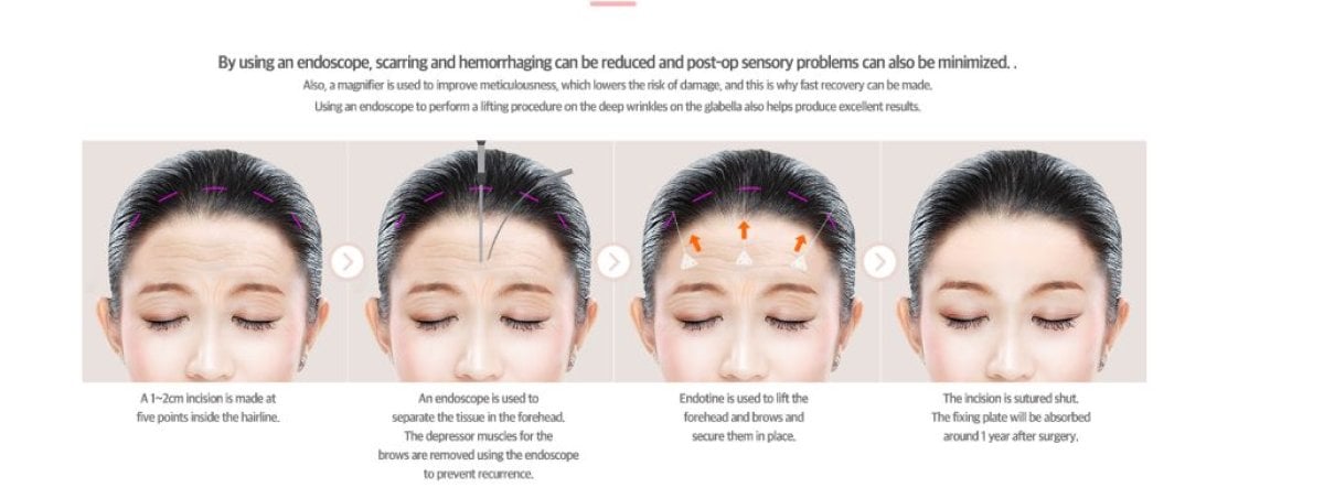 Etapy endoskopowego liftingu czoła w VG Plastic Surgery – technika podnoszenia brwi