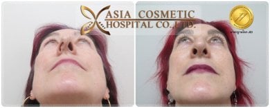 نتائج عملية تجميل الأنف قبل وبعد في Asia Cosmetic Hospital، تحسين شكل وتناسق الأنف
