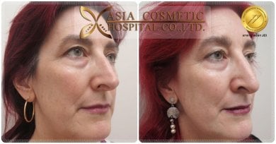 نتائج شد الوجه قبل وبعد في Asia Cosmetic Hospital، تأثير تجديد واضح للوجه