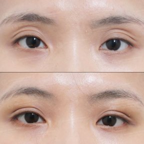 نتائج قبل وبعد حقن الدهون تحت العين في URBAN Plastic Surgery، امتلاء واضح أسفل العين