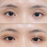 نتائج قبل وبعد حقن الدهون تحت العين في URBAN Plastic Surgery، امتلاء واضح أسفل العين