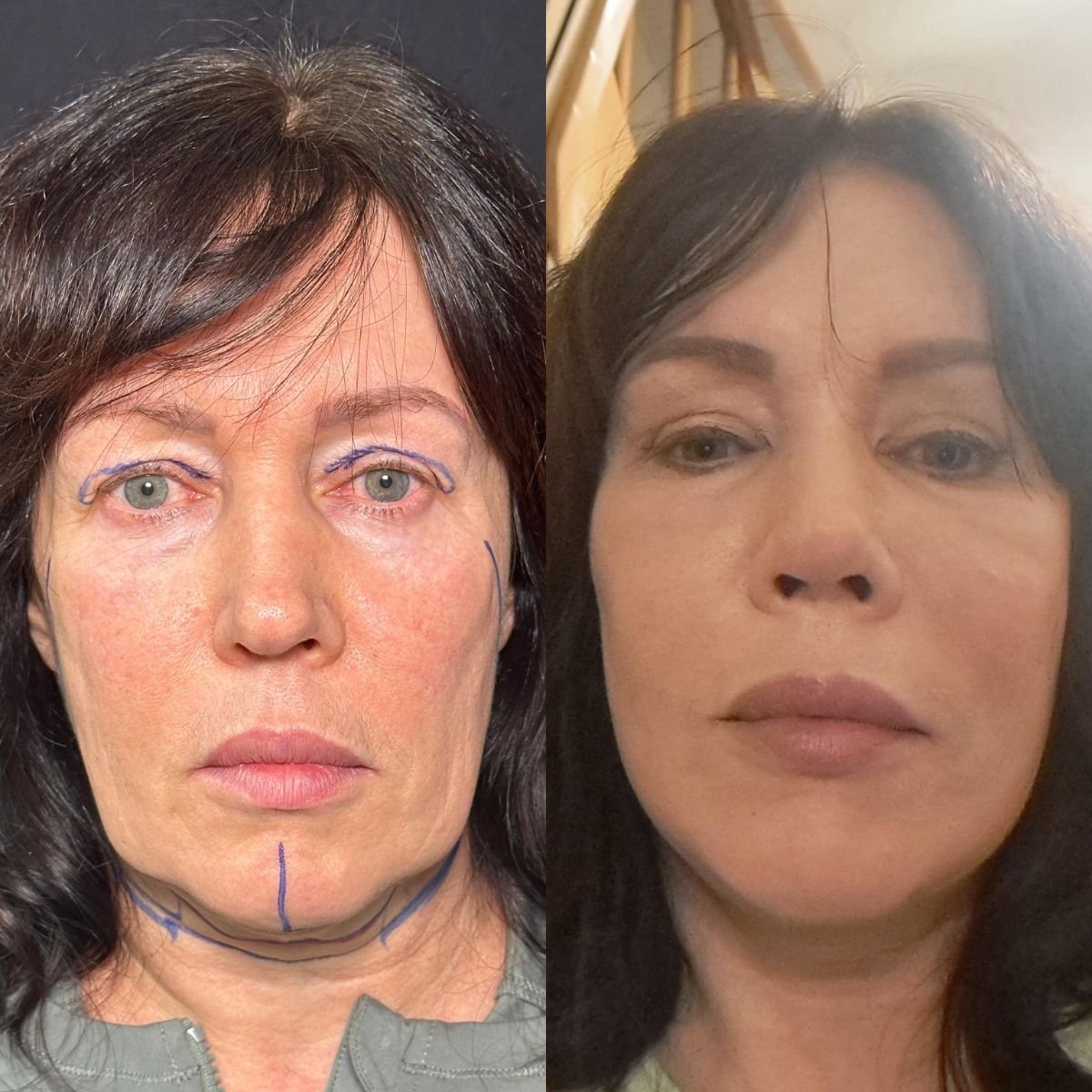 Facelift before and after results at Dr. Safa Manav Clinic, visible facial rejuvenation