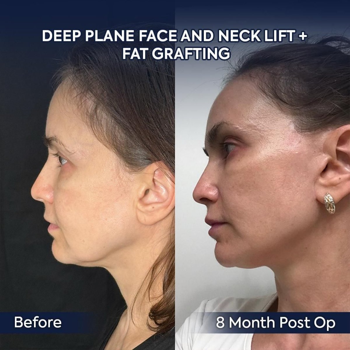 Before and after facelift and neck lift with fat grafting results at Dr. Safa Manav Clinic