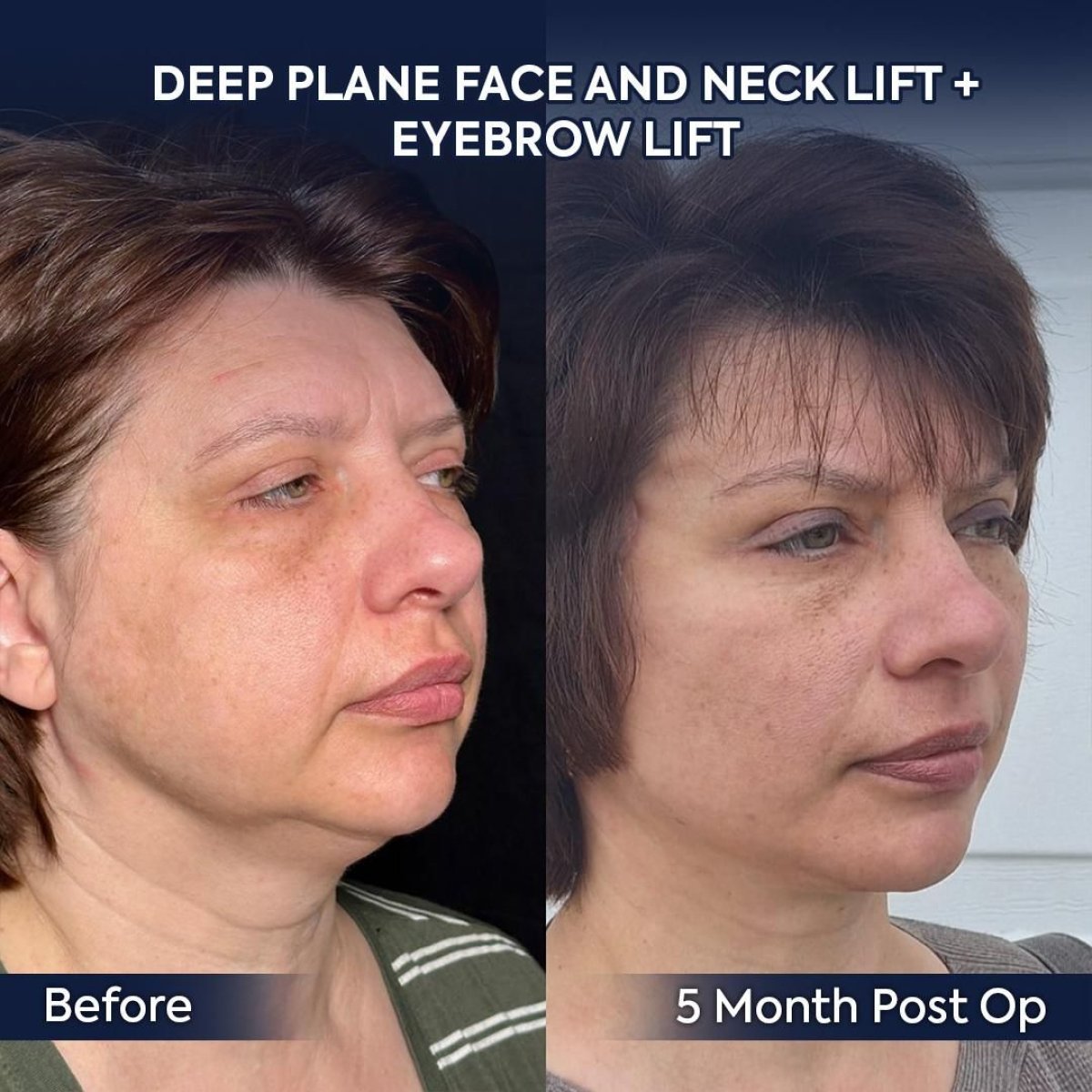 Before and after facelift and neck lift results at Dr. Safa Manav Clinic, 5 months post-op