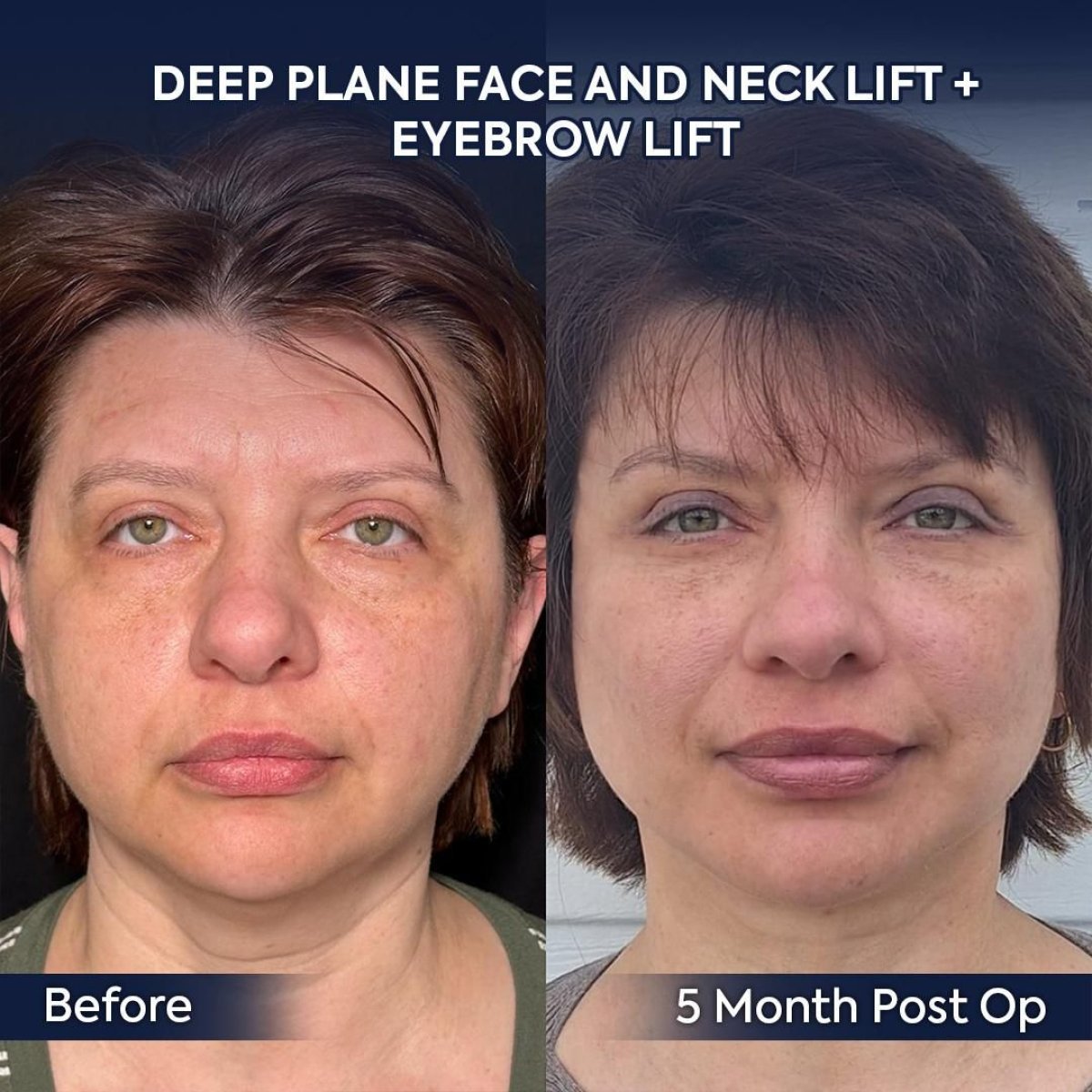 Before and after facelift and eyebrow lift results at Dr. Safa Manav Clinic, 5 months post-op