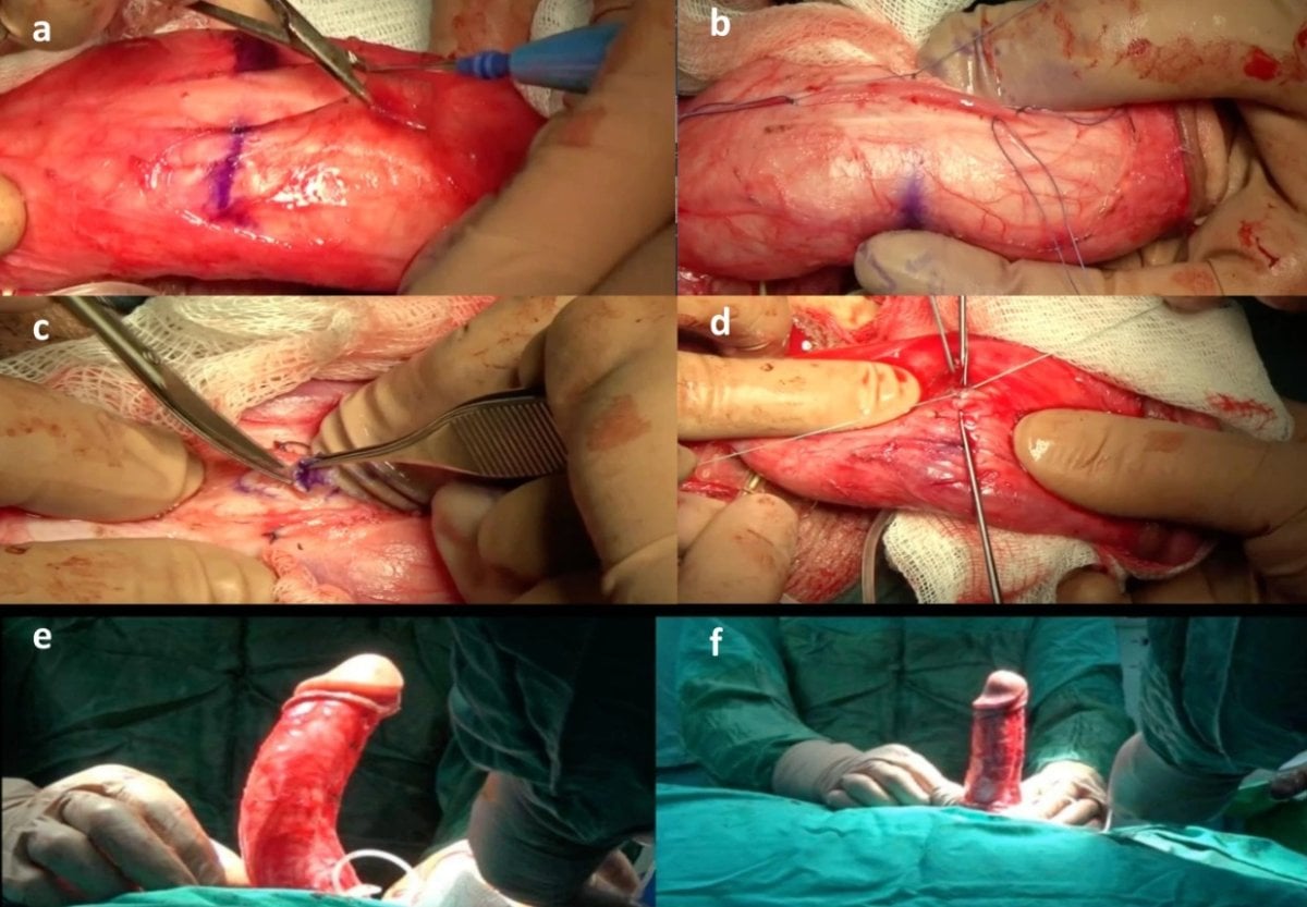 Хірургічна корекція викривлення статевого члена при хворобі Пейроні в Men's Health Clinics