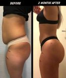 Back liposuction before and after results at Dr. Safa Manav Clinic, improved body contour