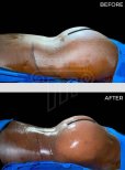 Before and after back liposuction results at Dr. Safa Manav Clinic, improved body contour