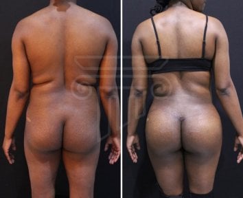 Before and after back liposuction results at Dr. Safa Manav Clinic, improved body contour