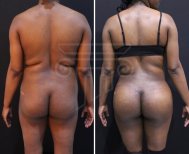 Before and after back liposuction results at Dr. Safa Manav Clinic, improved body contour