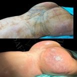 Before and after back liposuction results at Dr. Safa Manav Clinic, improved body contour