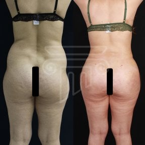 Before and after back liposuction results at Dr. Safa Manav Clinic, improved body contour
