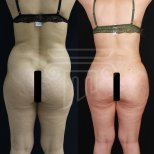 Before and after back liposuction results at Dr. Safa Manav Clinic, improved body contour