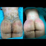 Before and after back liposuction results at Dr. Safa Manav Clinic, improved body contour