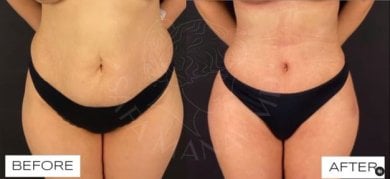 Before and after thigh liposuction results at Dr. Safa Manav Clinic, improved leg contour