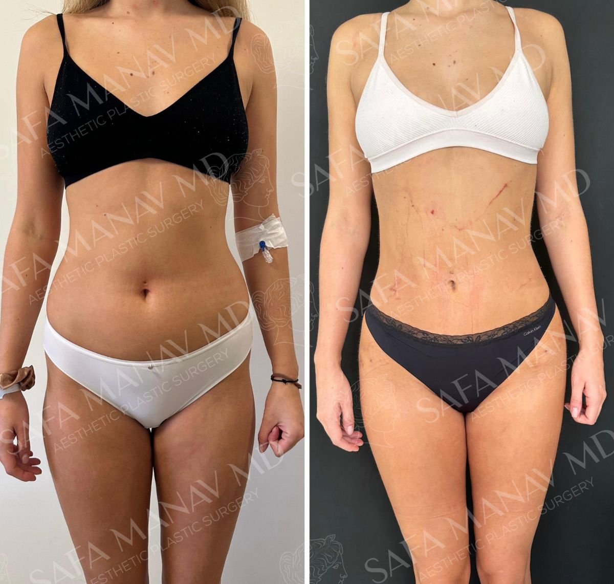 Resultados de liposucción de muslos antes y después en Dr. Safa Manav Clinic, mejor contorno