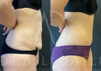 Vorher-nachher-Ergebnis Bauchdeckenstraffung bei Liv Hospital Ulus – flacherer Bauch