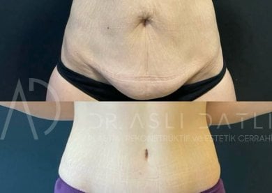 Vorher-nachher-Ergebnis Bauchdeckenstraffung bei Liv Hospital Ulus – flacherer Bauch