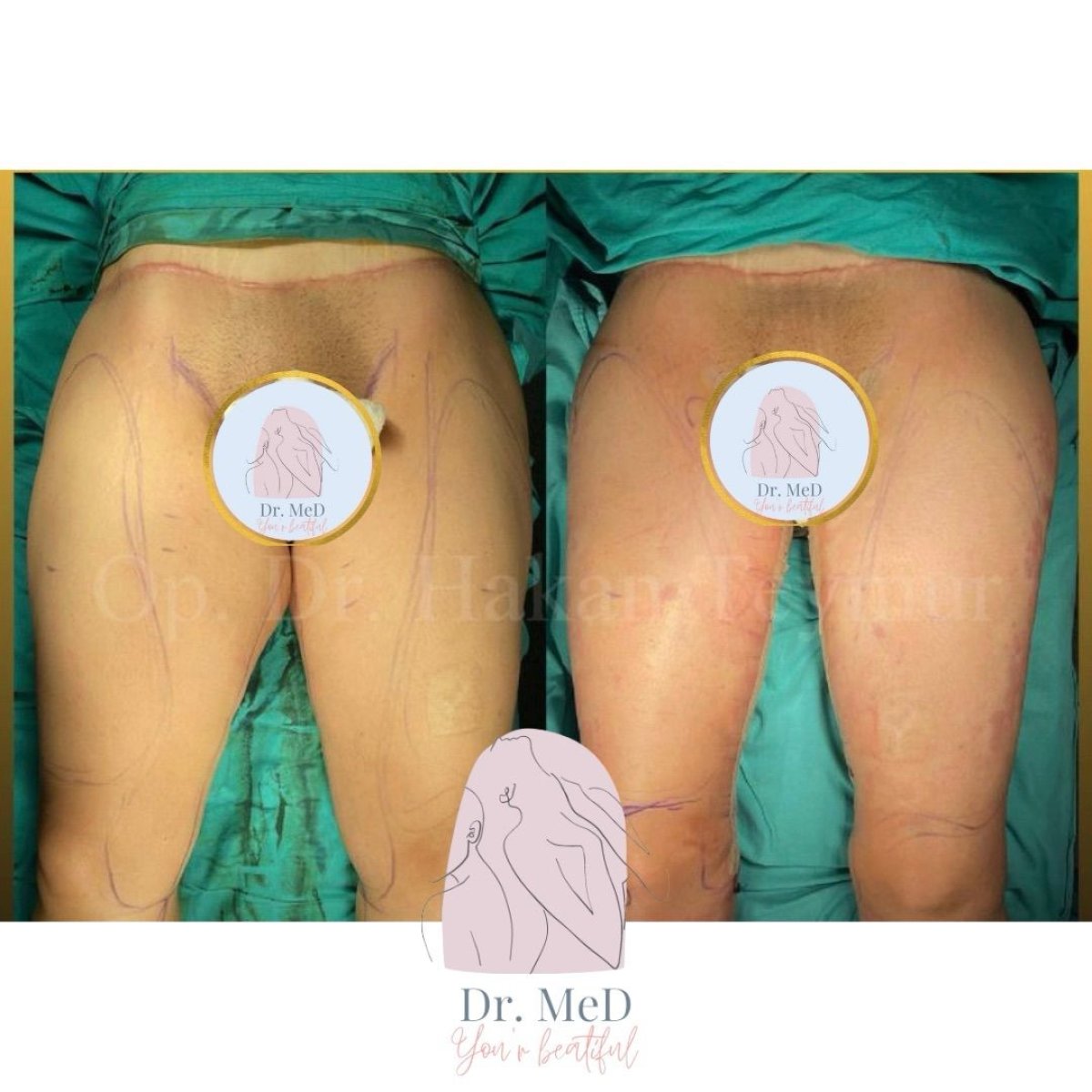 Résultats avant/après abdominoplastie chez Dr. MED, contour abdominal amélioré