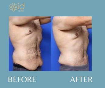 Before and after male tummy tuck results at ID Clinic Bangkok, improved abdominal contour