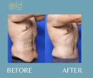 Before and after male tummy tuck results at ID Clinic Bangkok, improved abdominal contour