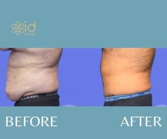 Before and after male tummy tuck results at ID Clinic Bangkok, improved abdominal contour
